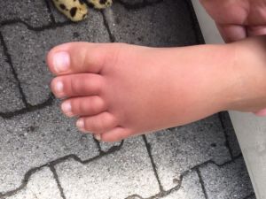 Schwer-entzuendliche-Mueckenstiche-Foto-IMG 6301